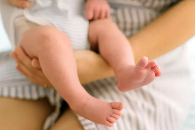 Bebeklerde Kalça Çıkıklığı Nedir? Nasıl Tedavi Edilir?